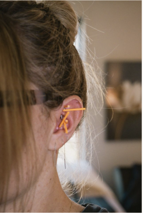 NADA ear acupuncture